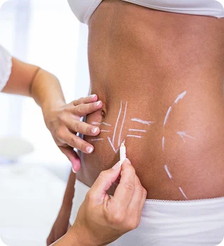 Cosmetic treatment markings on a woman’s abdomen