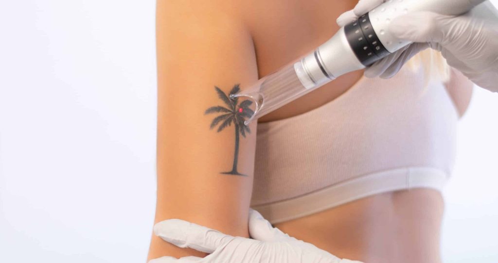 Laser Tattoo Removal