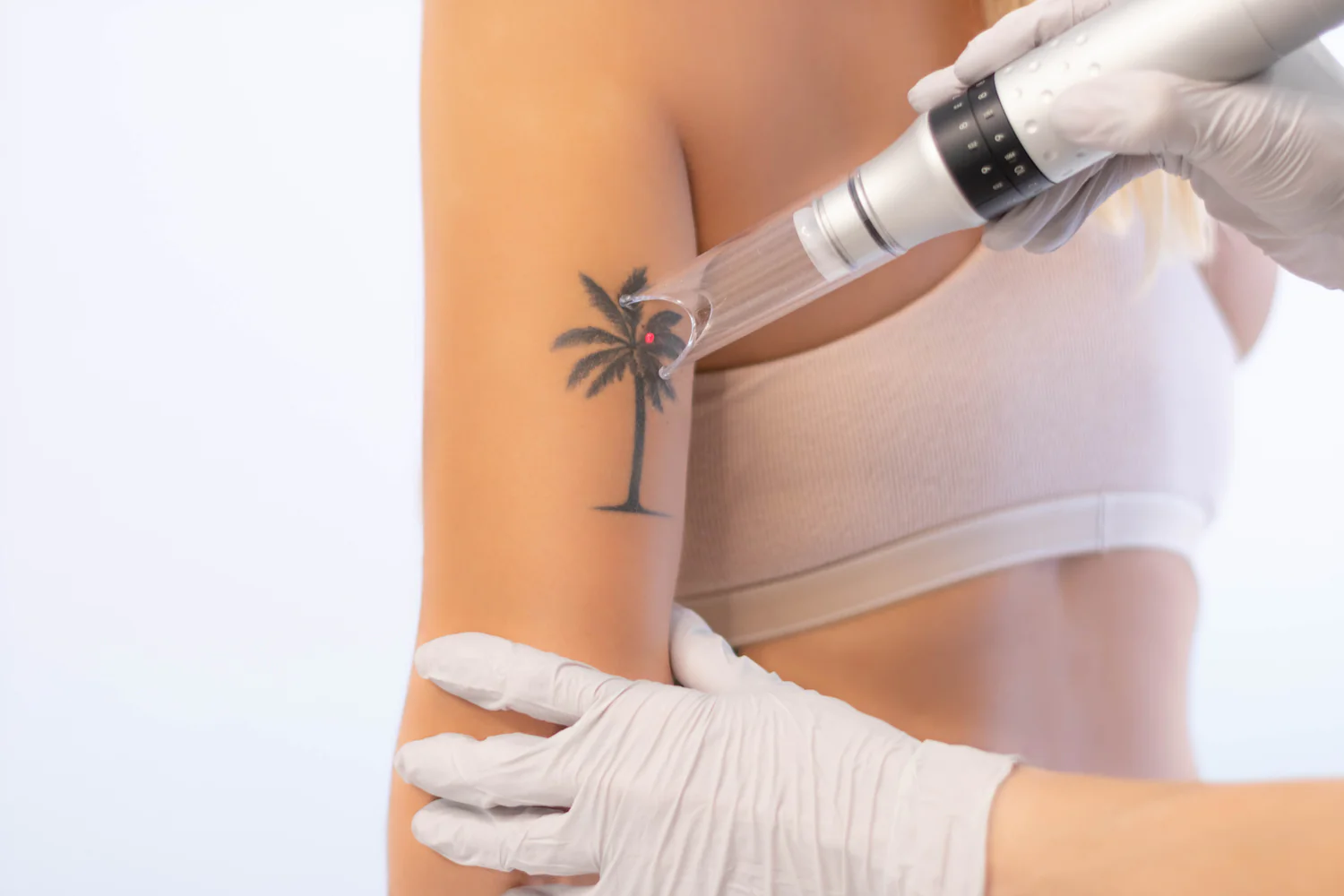 Preparing for Tattoo Removal | Lexington Tattoo Removal