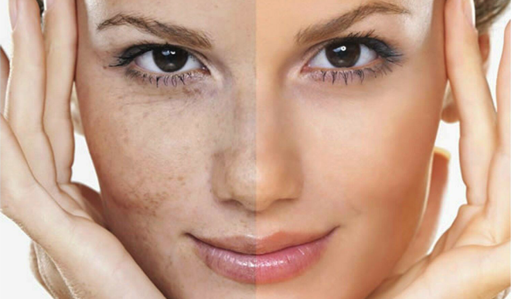 Laser Hyperpigmentation Treatment